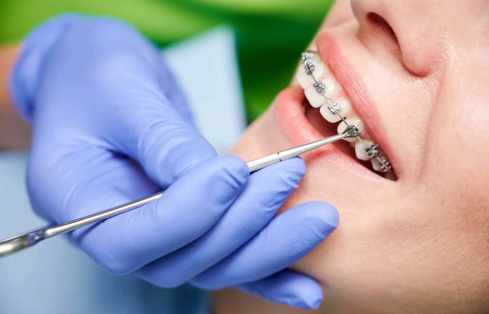 Benefits of braces in Seven Points, TX