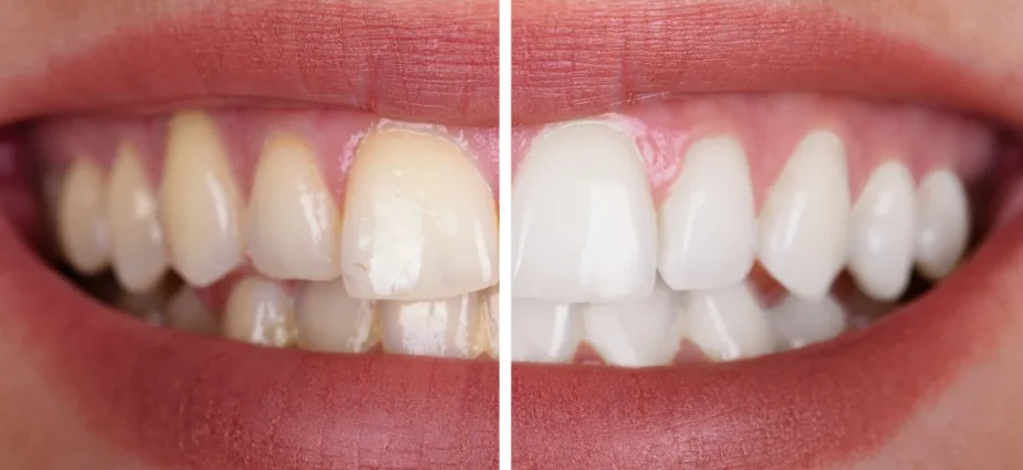 Teeth Cleaning and whitening