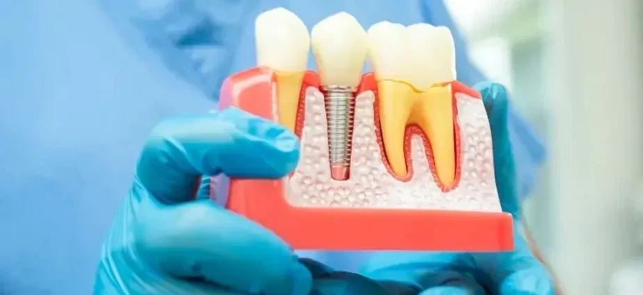 dental Implants in Texas dental Implants in Texas